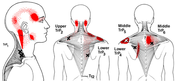 Chiropractic Care of the Upper Back